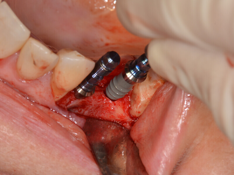 Fig. 11: Placement of the implants in regions #14 and 15.