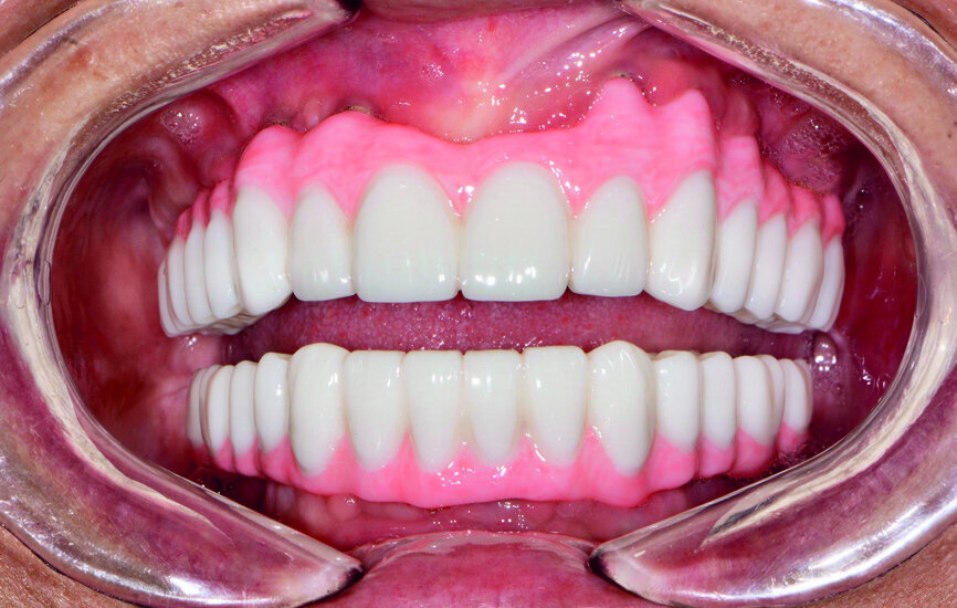 Fig. 21: Post-op retracted open-bite view.
