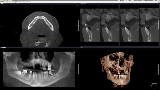 Webinar: Expert gives insights into CBCT-based diagnosis of trauma cases