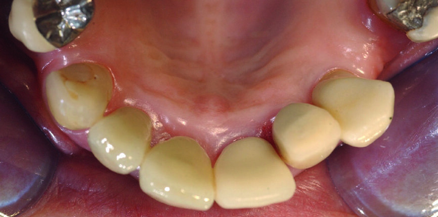 Figs. 17a et b : Vues cliniques de face et palatine. Notez la bonne adaptation des tissus mous. 