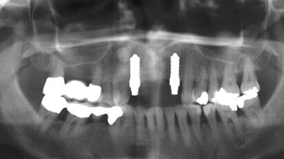 Vollkeramische Implantate – ein evidenzbasiertes Verfahren?