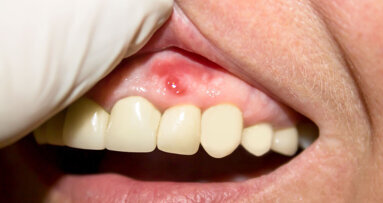 Research identifies potential novel treatment for managing periodontal disease