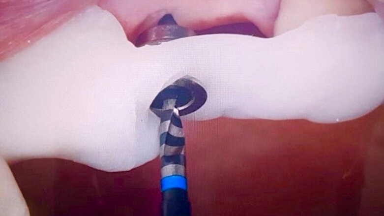 Guías Quirúrgicas Preformadas para implantología, ortodoncia y endodoncia