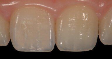 Moving beyond classical shade guides to achieve natural restorations