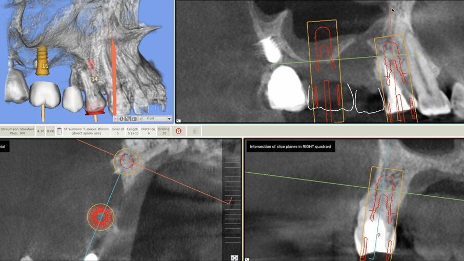 Fig. 2 - Visione radiografica pre-operatoria.