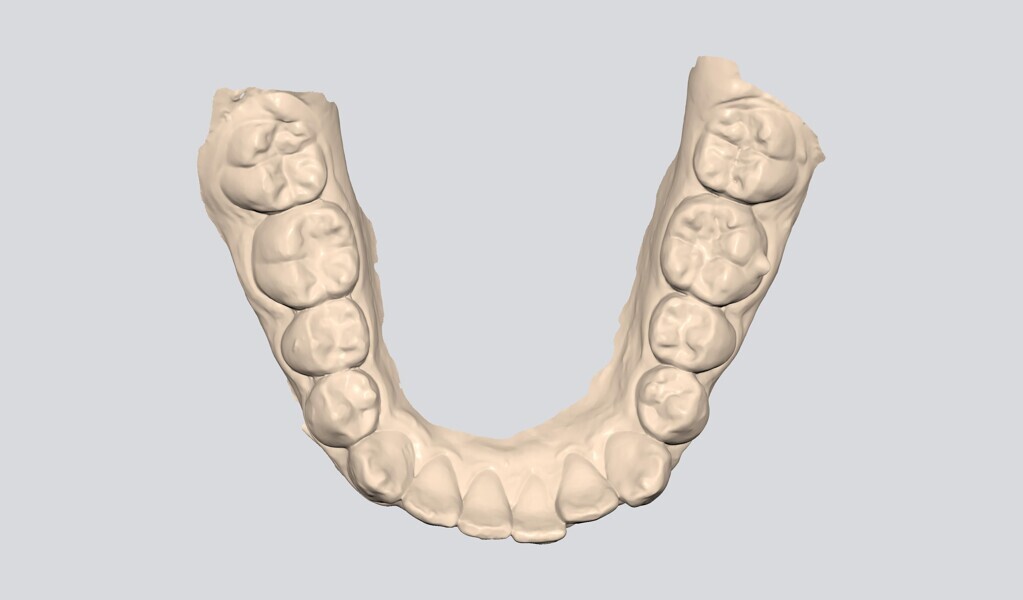 Figs. 16–20: Corresponding stage in the treatment plan simulation, showing good case tracking in relation to the clinical situation.