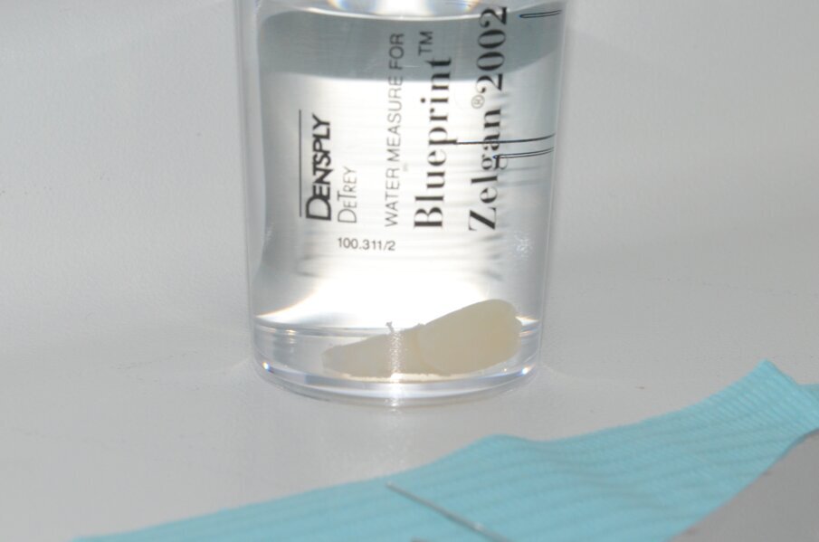 Figure 5b. Avulsed 21 with open apex was irrigated with saline as soon as the patient arrived to the clinic. Notice the tooth was held without touching the root to preserve the PDL tissue