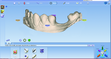 Restorative-driven implant therapy