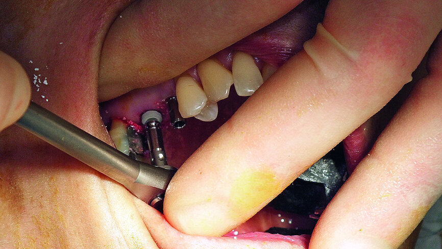 Fig. 16: Placement of 4.5 mm diameter and 6.6 mm length Ankylos C/X implant.
