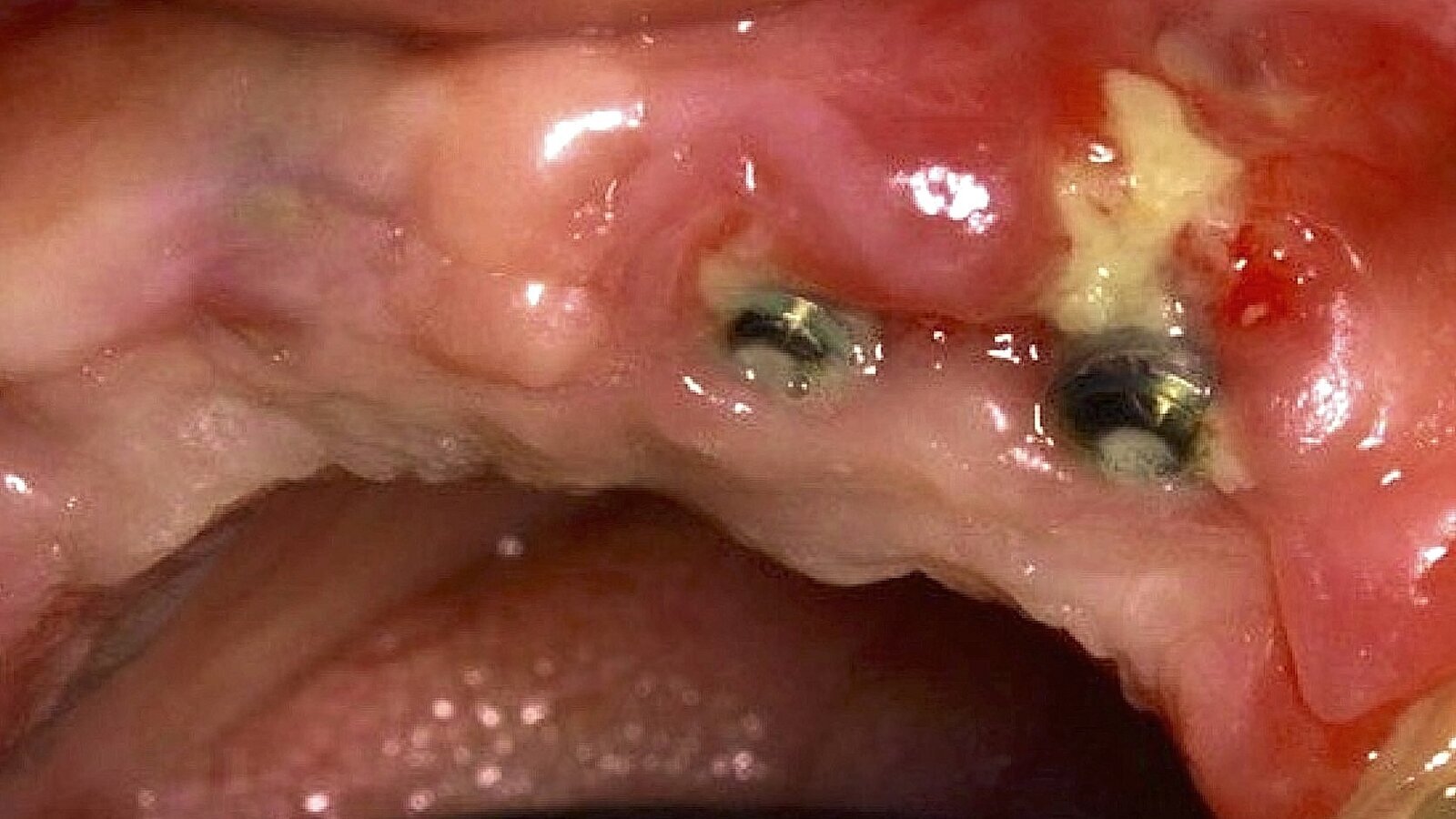 El rol del odontólogo en la osteonecrosis maxilar provocada por anticuerpos monoclonales