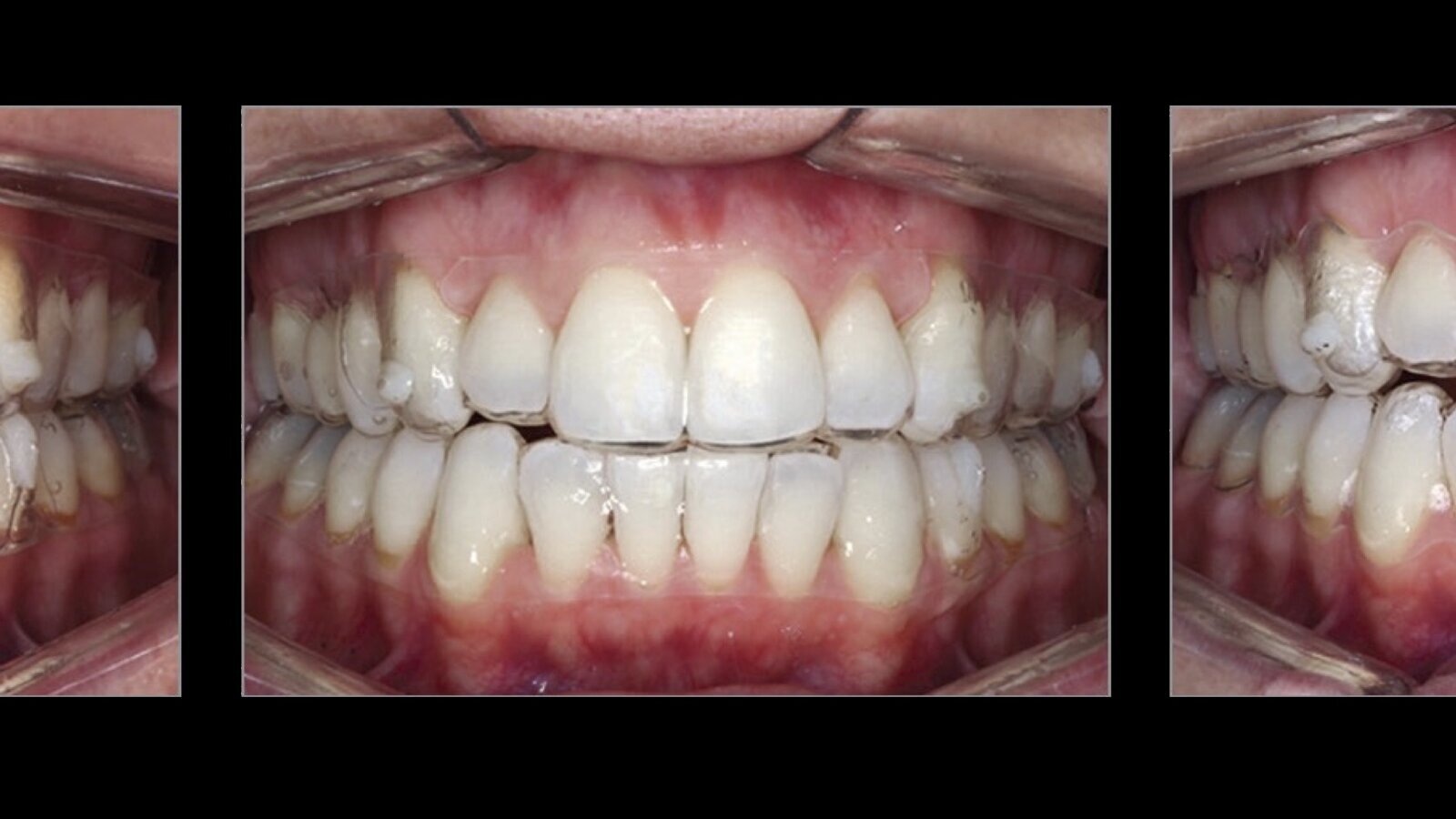 Estética y blanqueamiento dental en la era digital  (Capítulo 16)