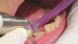Figs. 4. Uso de los finos insertos para crear espacio entre hueso, ligamento y diente.