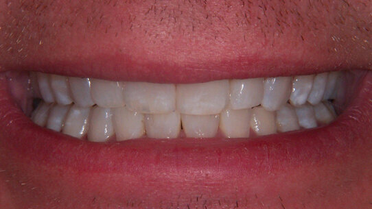 Principi biomimetici applicati all’odontoiatria cosmetica