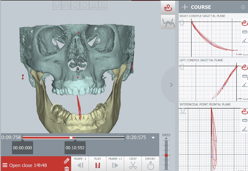Fig. 42: Condylar and incisor graph recordings during opening and closing after splint therapy.