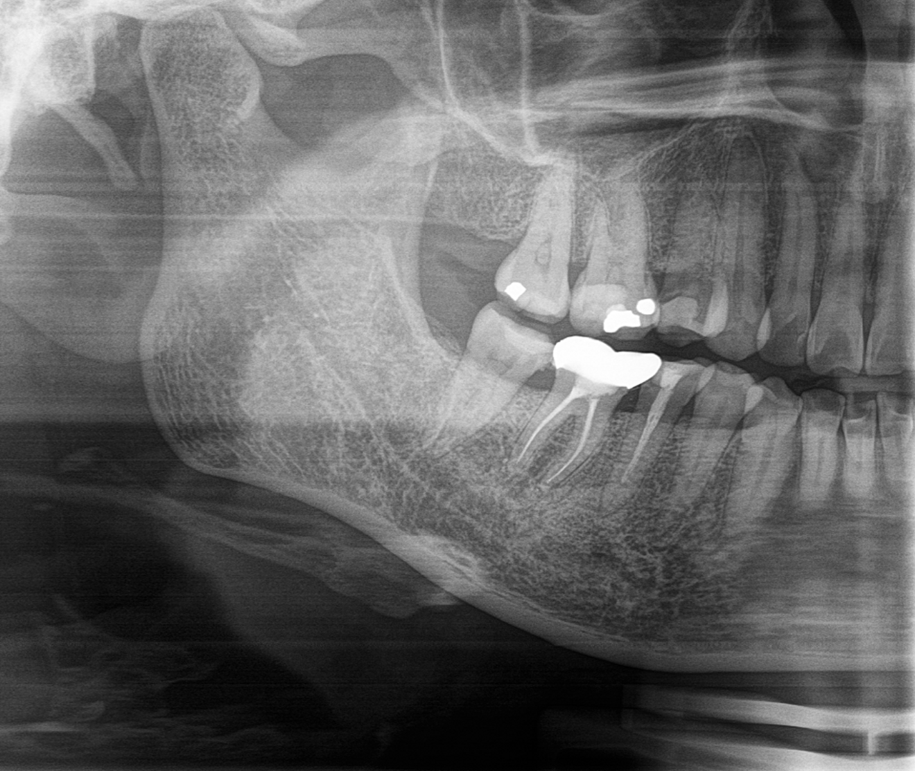 Fig. 5: Three-month follow-up radiograph showing no inflammation in the area of tooth #46.