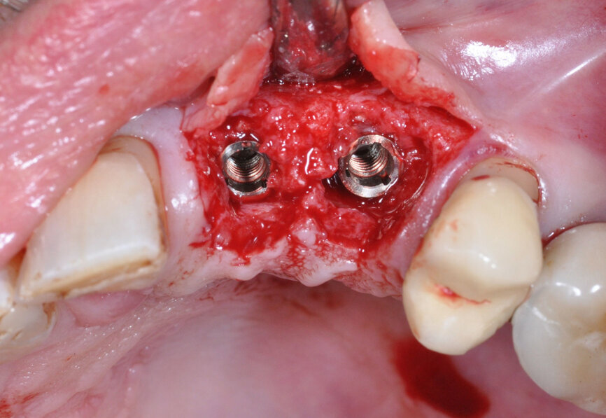 Implant site at which soft-tissue enhancement was performed to prevent peri-implantitis. (Image: Inga Boehncke)
