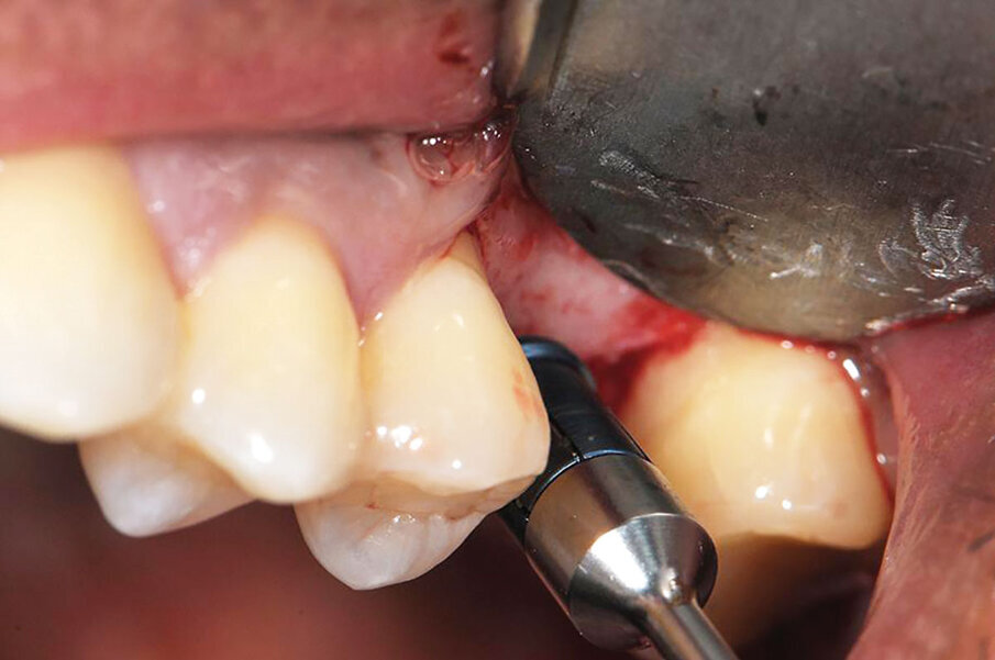 Fig. 5: ‘Gummy bone’ being introduced into the osteotomy where a crestal sinus elevation has been performed to increase the crestal height prior to implant insertion.
