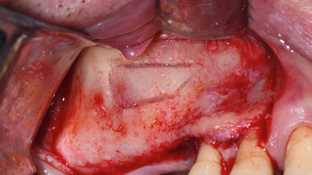 Il “Sinus Pack” per il rialzo di seno mascellare: una nuova tecnica