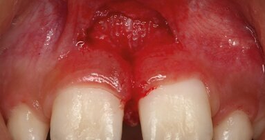 Les lasers Erbium en odontologie pédiatrique