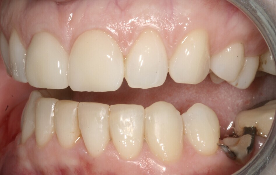 Fig. 7: 2004—lateral view of the new ceramic crown and veneer.