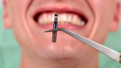 Una ricerca rivela nei pazienti equivoci fondamentali in tema di impianti dentali
