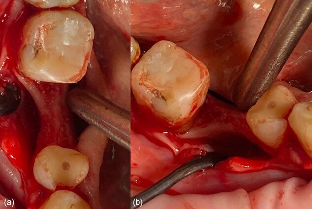 Fig. 4_Situazione clinica dopo l’elevazione del lembo: a) vista occlusale, b) vista vestibolare.