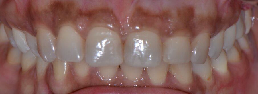 Fig 10: After the restorative & digital occlusal analysis