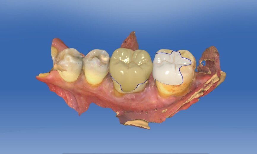 Fig. 5a: CAD construction in the mandible.