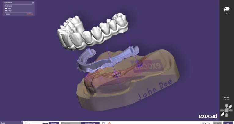 Using the split denture workflow in exocad’s DentalCAD 3.3