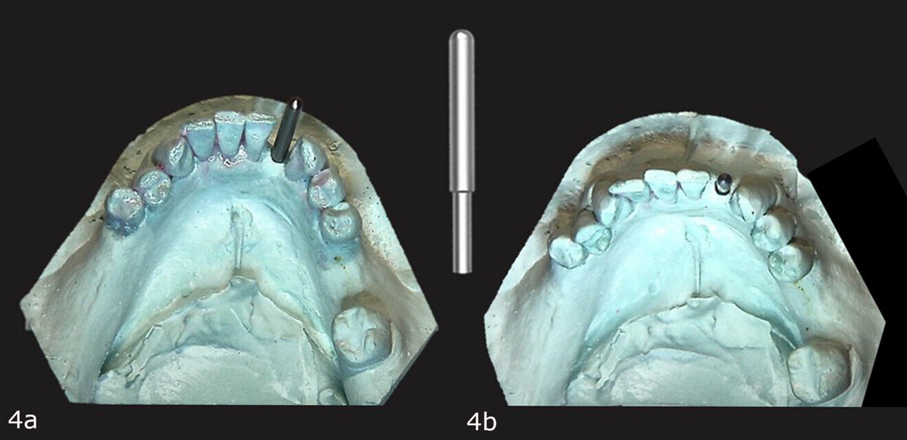 Figs. 4a & b: Guide post is inserted into the pilot hole made with the drill in the model (a & c). Guide Right guide post (b).