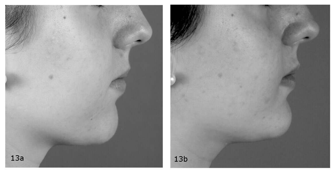 Figs. 13a & b: Pre- (a) and post-treatment (b) comparison of the facial profile.