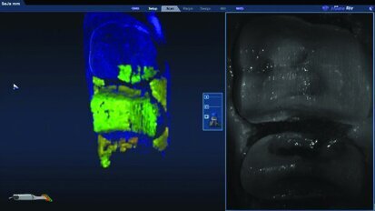 A minimally invasive approach according to biomechanical principles of teeth