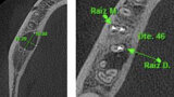 Figura 1. Inclinación de la raíz distal del primer molar inferior derecho hacia lingual. Ubicada aproximadamente a 10 mm de la cortical ósea vestibular, lo que hace imposible hacer el abordaje quirúrgico a través de microcirugía.