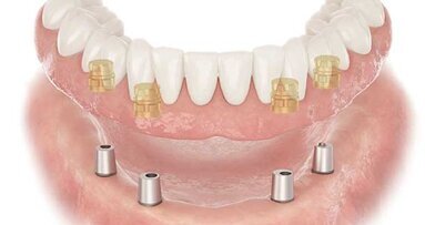 Do you know enough about the implant company you work with?