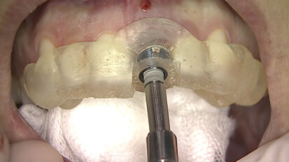 Il razionale del posizionamento implantare tridimensionale protesicamente guidato nei settori estetici