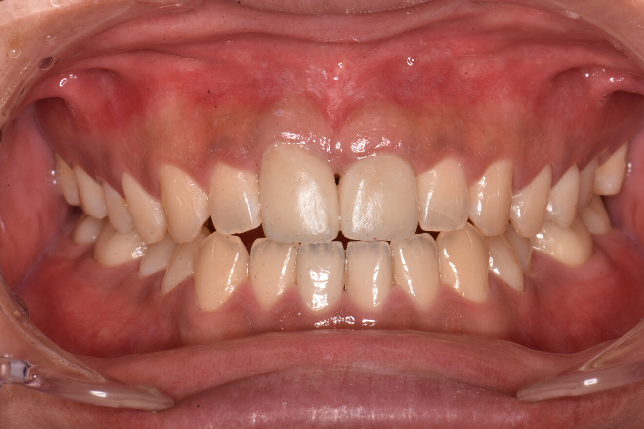 Fig. 4c: Crowns in situ.