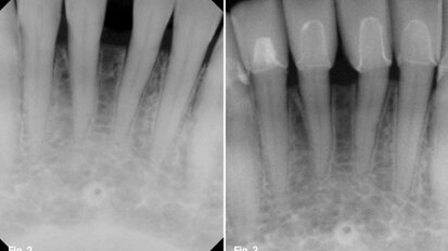 The importance of gingival health in a functional cosmetic case