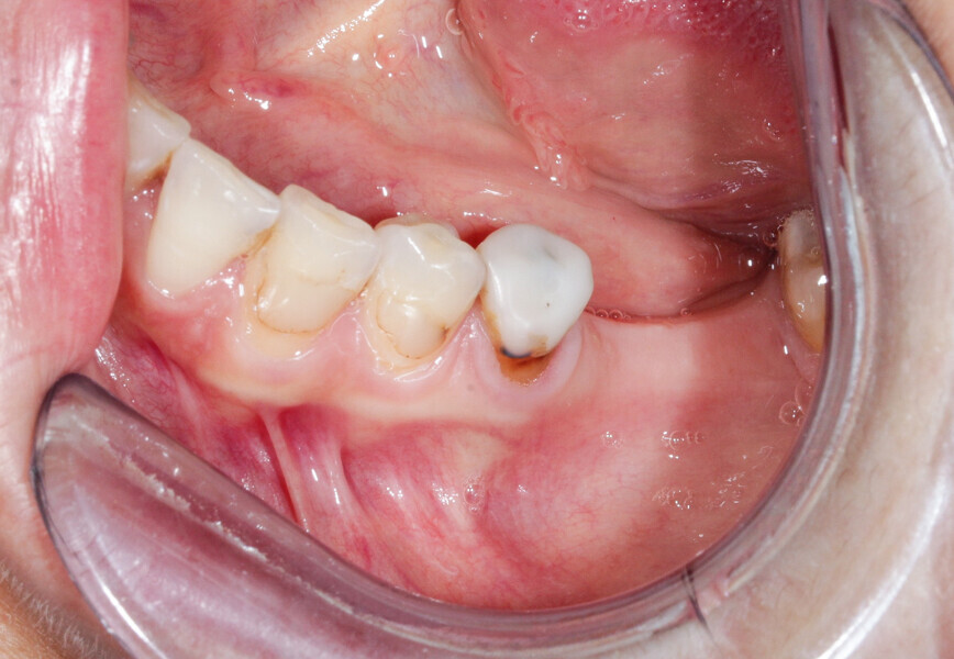 Fig. 4: Serious risk of dehiscence.