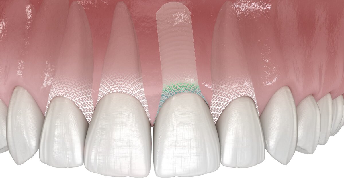 Symbionic Teeth : nouvelle approche du remplacement dentaire