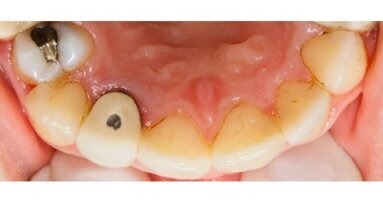 L’utilizzo dei probiotici nel controllo delle black stains