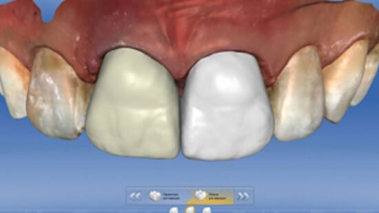 Fig. 5. En el diente 11 se diseñó una corona completa de VITA SUPRINITY PC, y en el 21 una carilla de VITABLOCS Mark II.