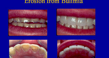 Dentists are often able to spot eating disorders in patients