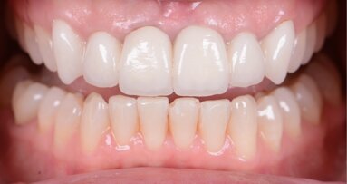 A bright new smile with KATANA Zirconia YML