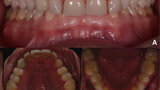Fig. 1. Fotografías intraorales iniciales, vista frontal (A), vista oclusal del maxilar (B) y vista oclusal de la mandíbula (C).