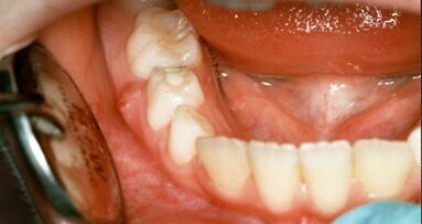 Milchzahnendodontie in der zahnärztlichen Allgemeinpraxis