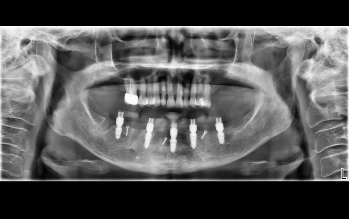 Fig. 7: Panoramic radiograph for scan body verification.