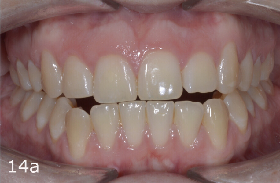 Figs. 14a–h: Intra-oral comparison of the situation (a, d, e & h) before and (b, c, f & g) after treatment.
