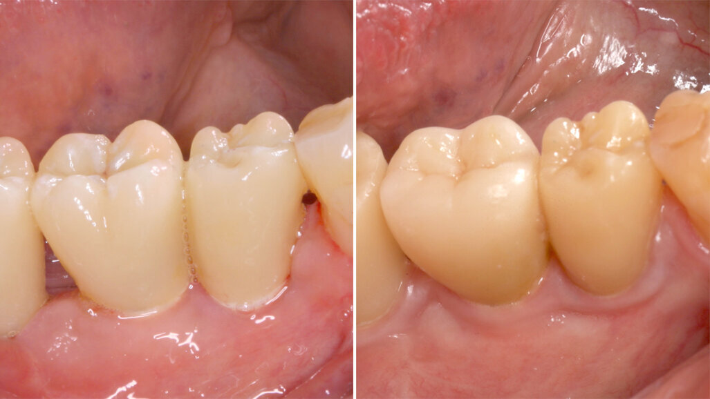 First long-term study on two-piece zirconia implants published