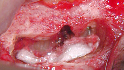 Apical microsurgery: access and crypt management (Part 3)