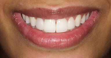 Meeting patients' needs and transforming smiles with direct veneers